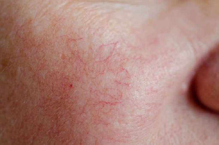Close up of human face skin with vascular problems, couperose on sensitive skin