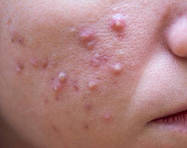 Discover how Roaccutane transforms severe acne, its side effects, treatment journey, and what to expect before, during, and after.