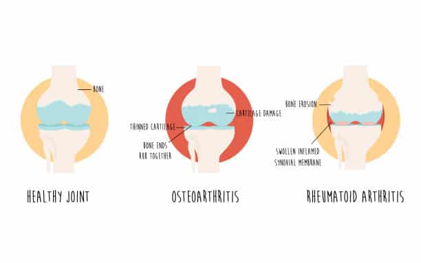 Illustration comparing osteoarthritis and rheumatoid arthritis affecting human joints
