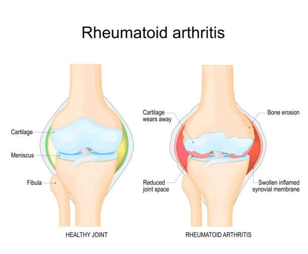 Illustration comparing osteoarthritis and rheumatoid arthritis affecting human joints